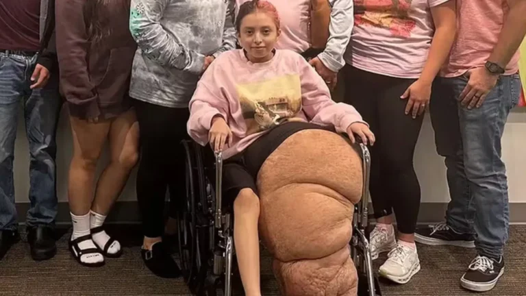 garota-de-14-anos-passa-por-cirurgia-de-17h-para-remover-a-perna-de-79kg