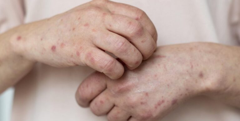 bahia-investiga-novo-caso-suspeito-de-mpox