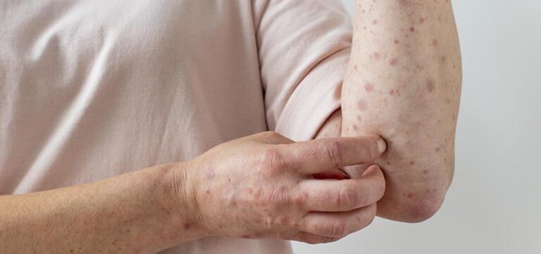 sobe-para-140-numero-de-casos-confirmados-de-mpox-no-pais,-em-2026