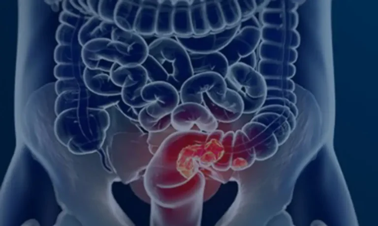 sus-adota-novo-exame-para-rastrear-cancer-colorretal-na-populacao