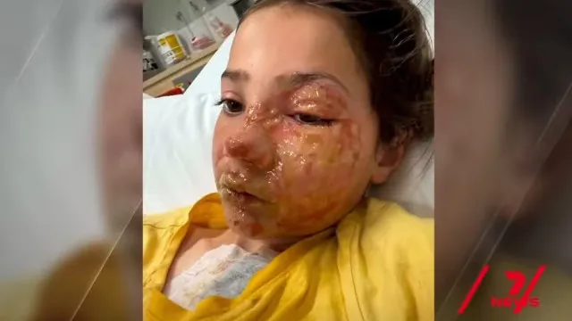 Menina De 10 Anos Sofre Queimaduras No Rosto Após Fazer Desafio Do TikTok menina-de-10-anos-sofre-queimaduras-no-rosto-apos-fazer-desafio-do-tiktok
